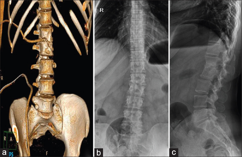 (a) Computed tomography image postoperative showing the position of two drain tubes in intervertebral disc and psoas abscess, respectively. The patient ambulated the same day, (b and c) radiographs at 3-year follow-up showinghealed lesion